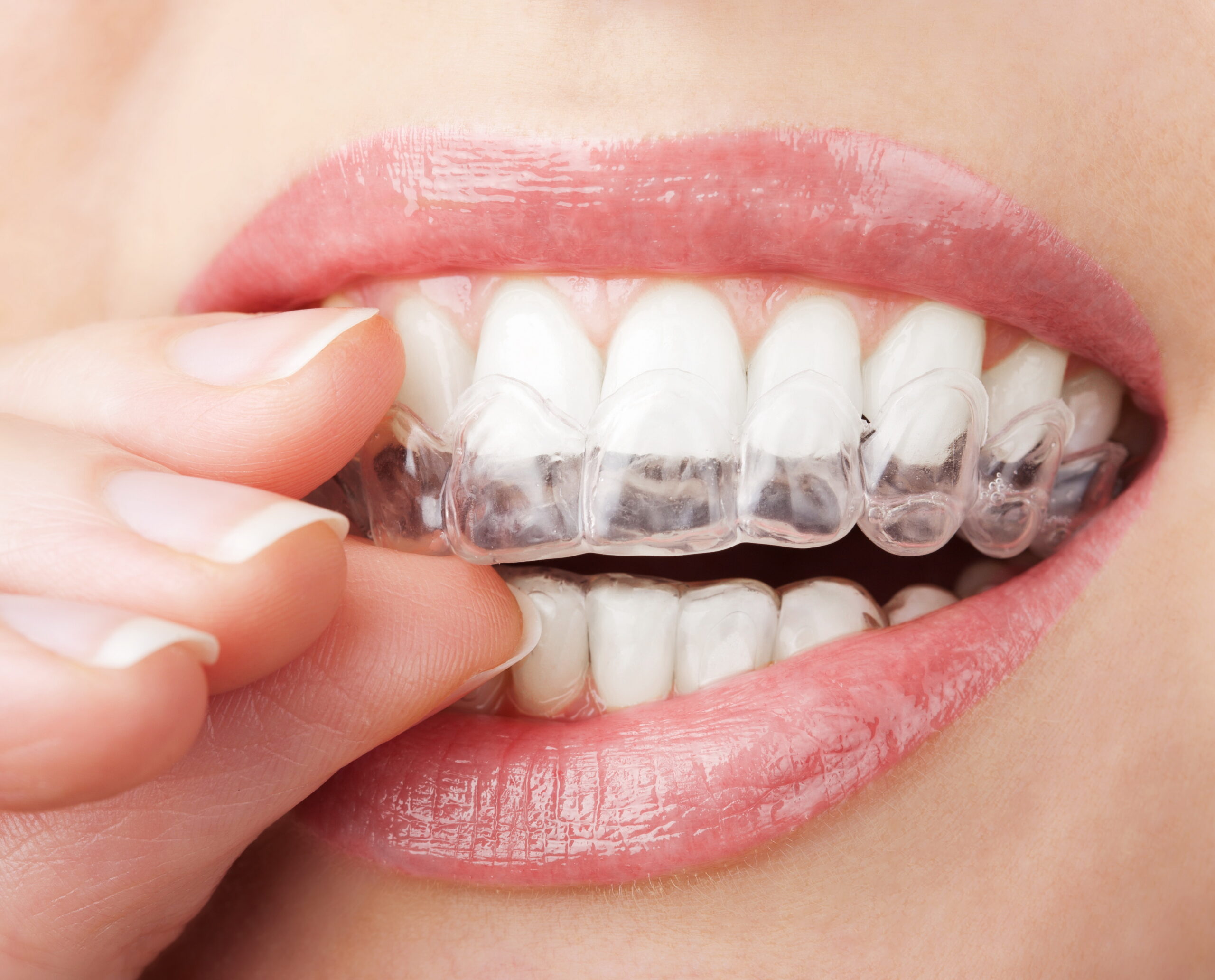 Frenillo labial superior