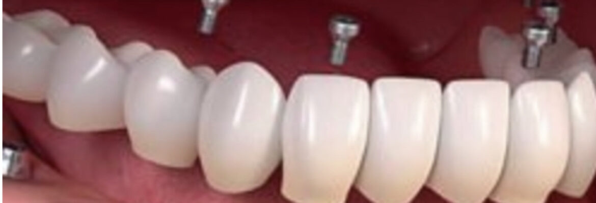 Clínica de Implantología Oral Del Valle
