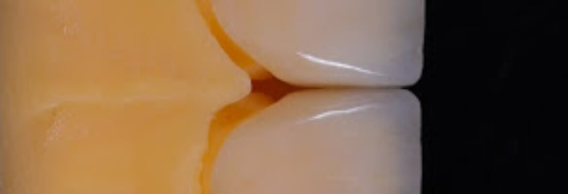 Implantes dentales – Periodoncista – Diseño de sonrisa | Implantes estratégicos Ibague Dra Johanna Calderón, surgimedica