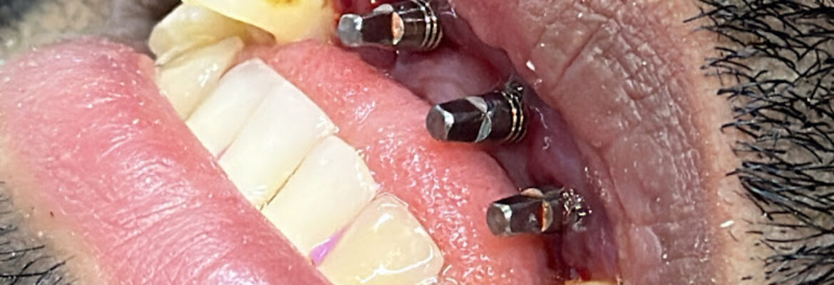 Dental Implants in Cartagena / Veneers / Implantes dentales y Diseños de sonrisa en Cartagena Dra Johanna Calderón