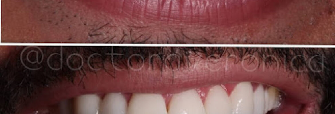 Doctora Veronica Diseño de Sonrisa en Bogotá Carillas de Porcelana Implantes Dentales Ortodoncia Invisalign